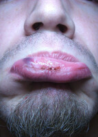 Yo I Gotta Fat Lip